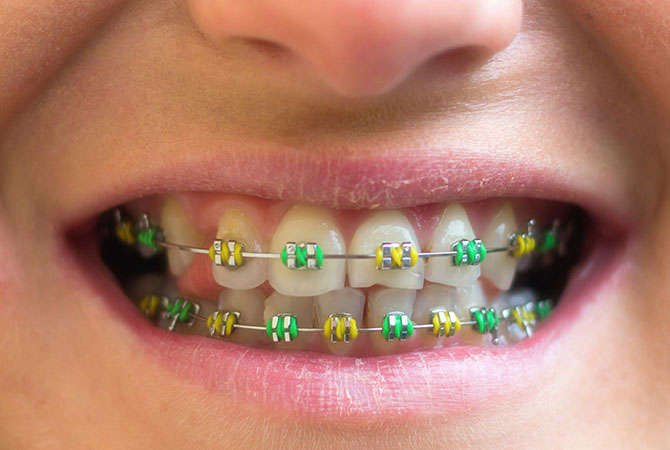 A close-up shot of teeth with braces 